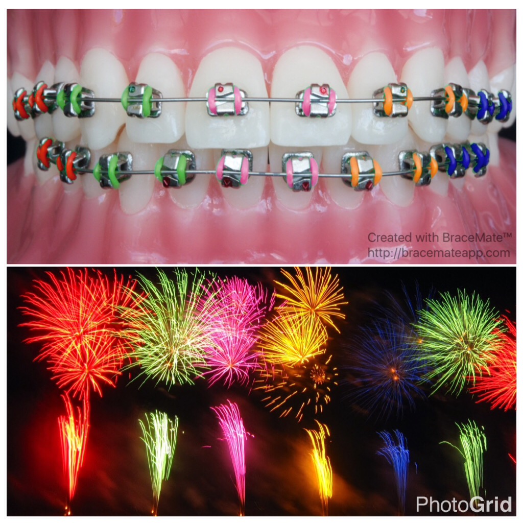 New years eve braces colors – EndoPrepApp