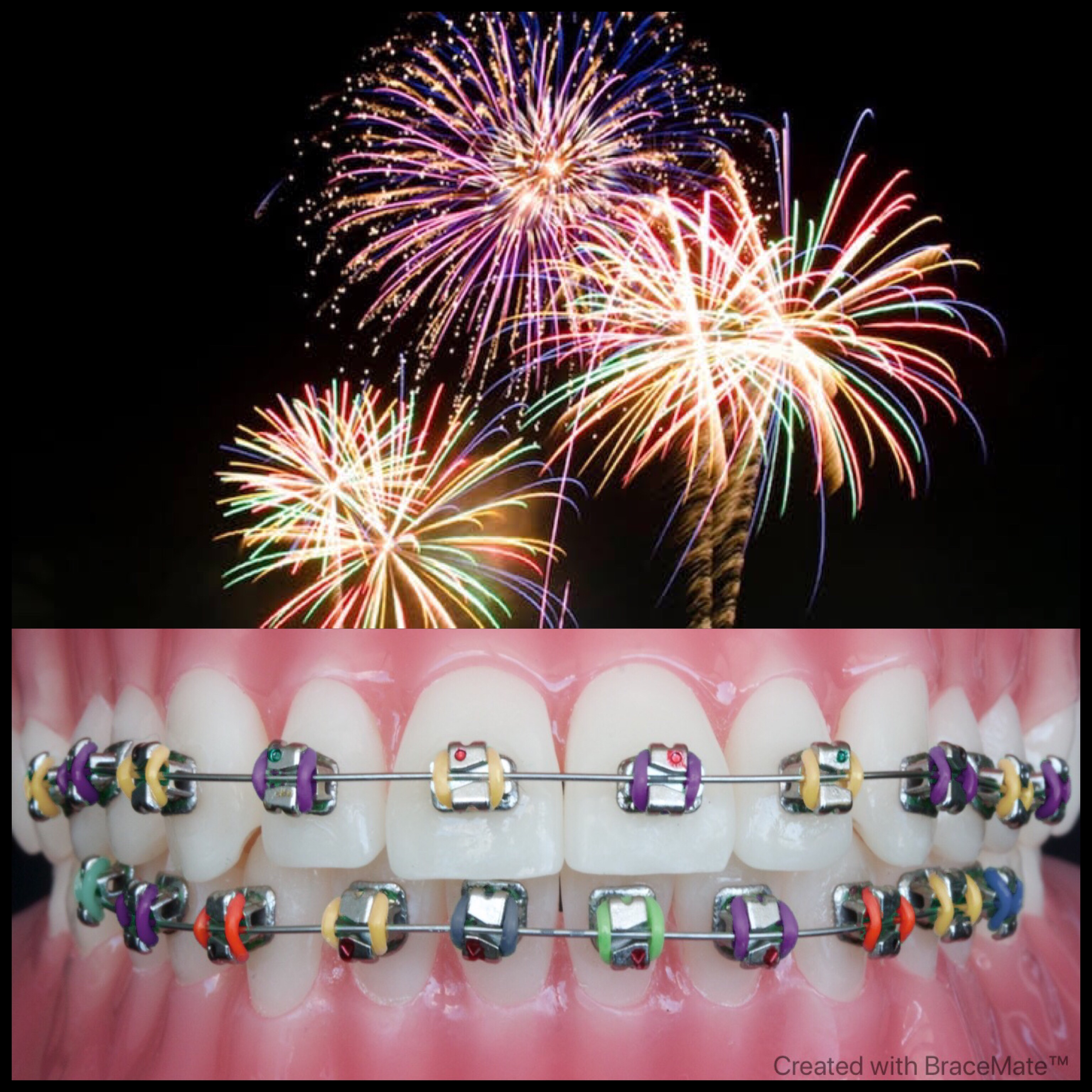 New Years braces colours – EndoPrepApp